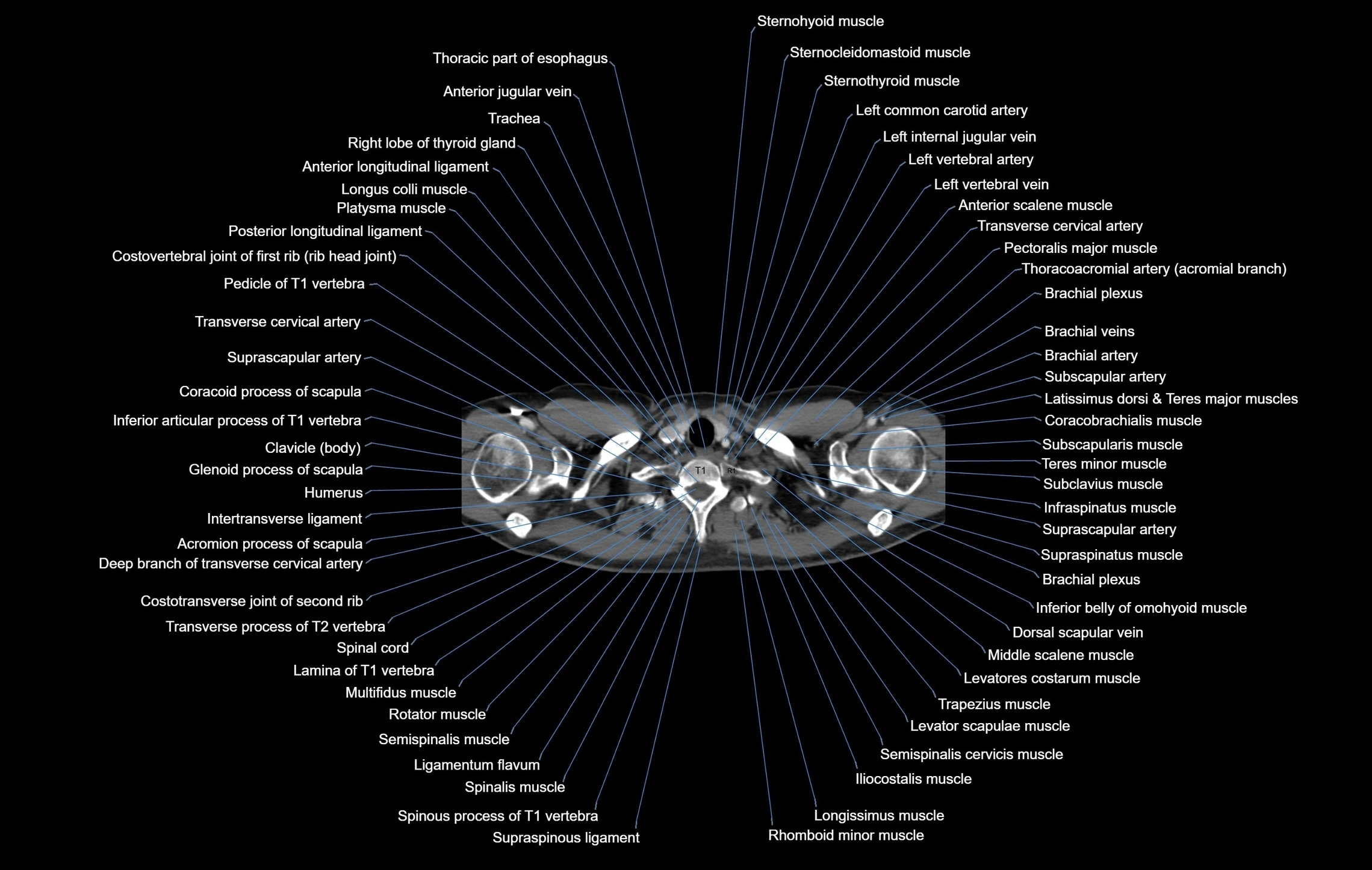 CT chest (thorax) labelled axial cross sectional anatomy radiology image-00004.webp